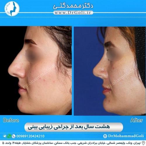 جراحی زیبایی بینی 147