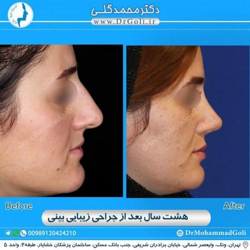 جراحی زیبایی بینی 148