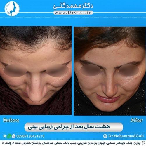جراحی زیبایی بینی 149