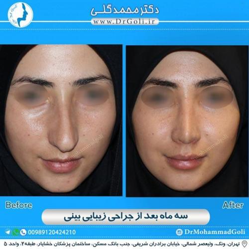 جراحی زیبایی بینی 150