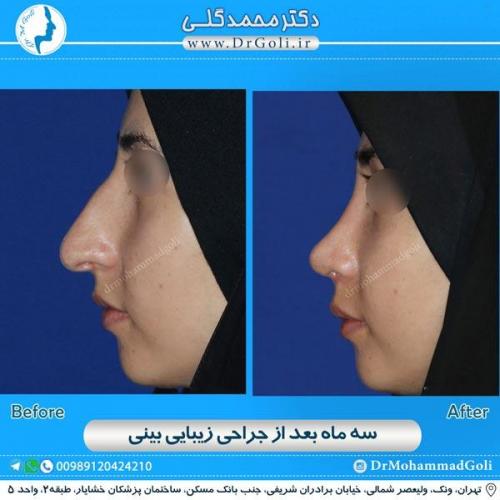 جراحی زیبایی بینی 151