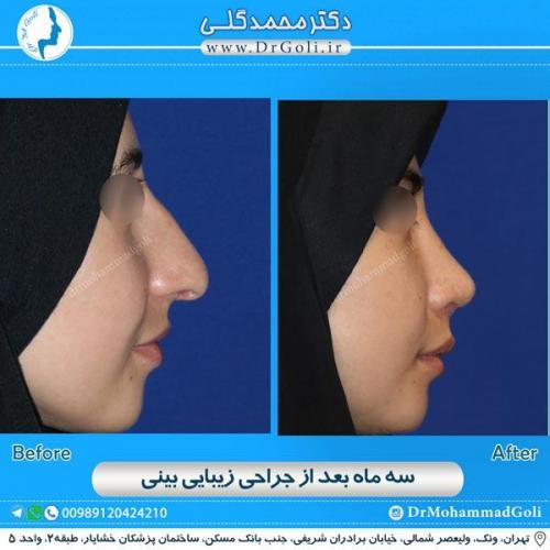 جراحی زیبایی بینی 152
