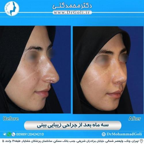 جراحی زیبایی بینی 153