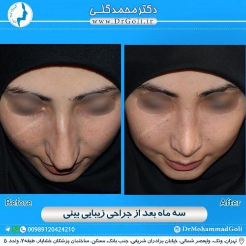 جراحی زیبایی بینی 154