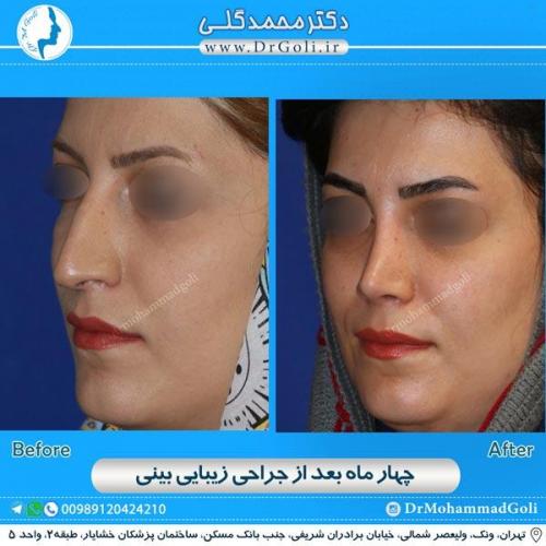 جراحی زیبایی بینی 159