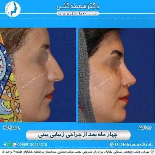 جراحی زیبایی بینی 160