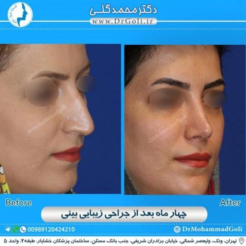 جراحی زیبایی بینی 161