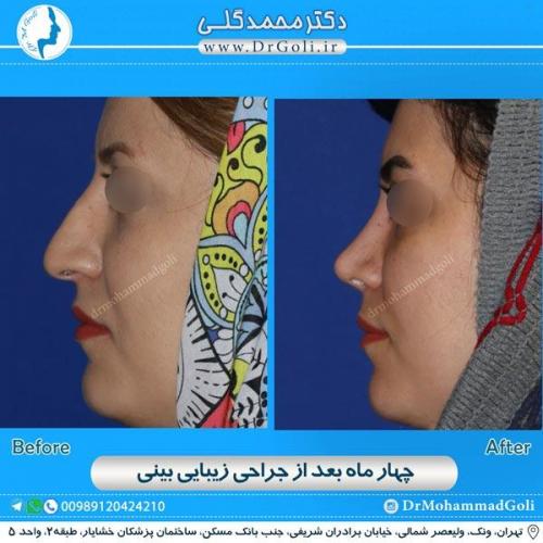 جراحی زیبایی بینی 162