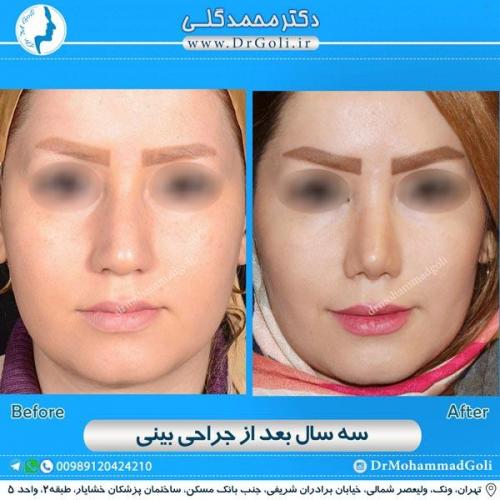 جراحی زیبایی بینی 163