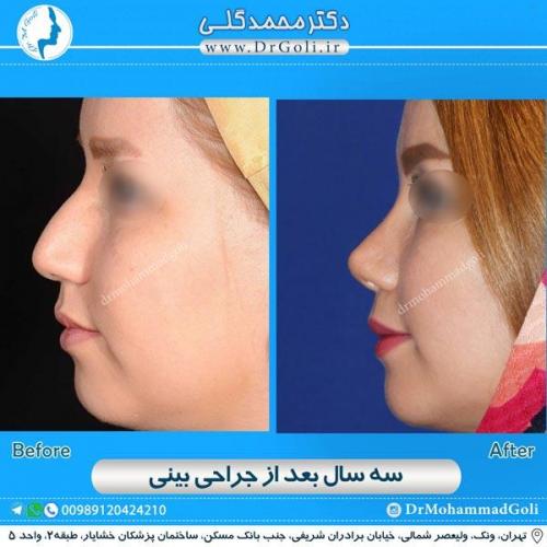 جراحی زیبایی بینی 164