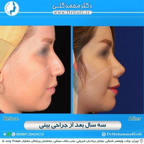 جراحی زیبایی بینی 165