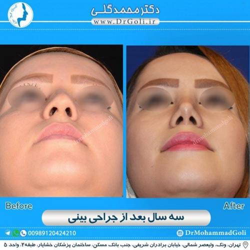جراحی زیبایی بینی 166