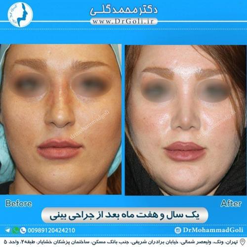 جراحی زیبایی بینی 167