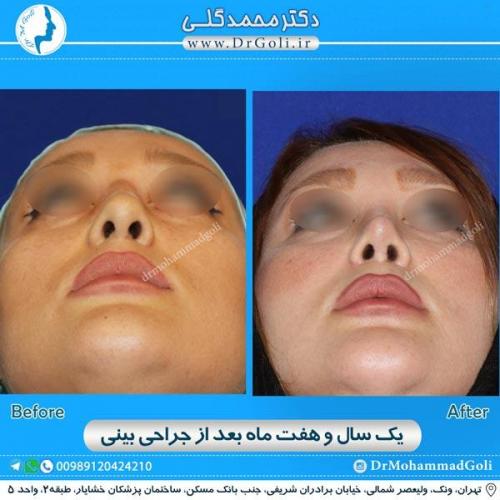 جراحی زیبایی بینی 168