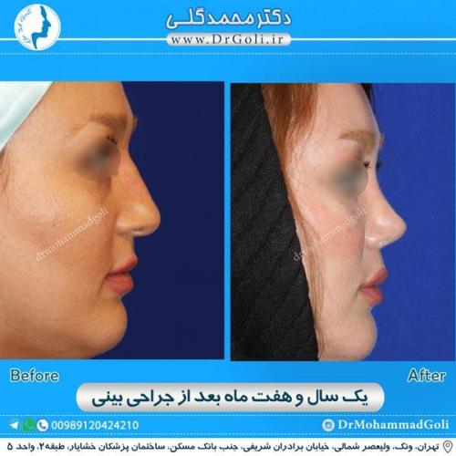 جراحی زیبایی بینی 169