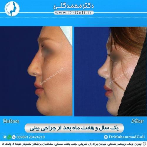 جراحی زیبایی بینی 170