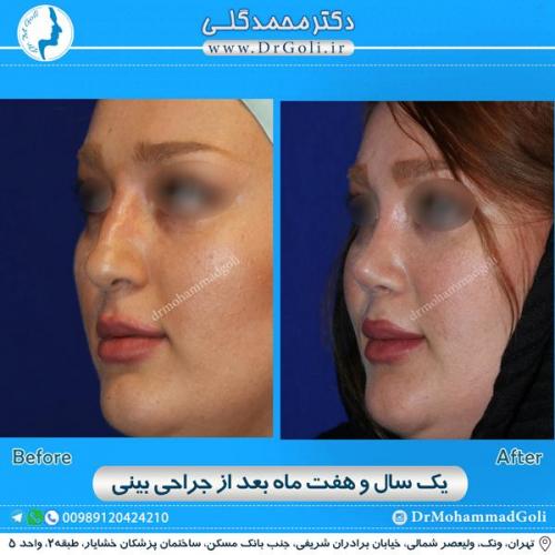 جراحی زیبایی بینی 171