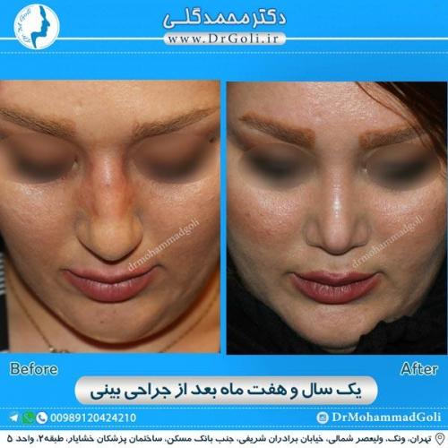 جراحی زیبایی بینی 172