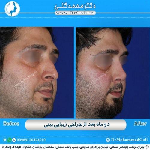 جراحی زیبایی بینی 180