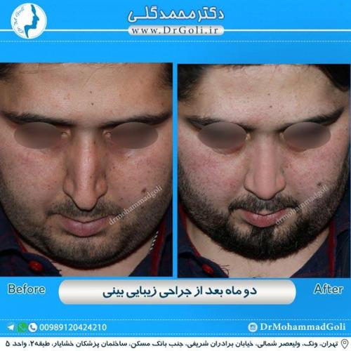 جراحی زیبایی بینی 184