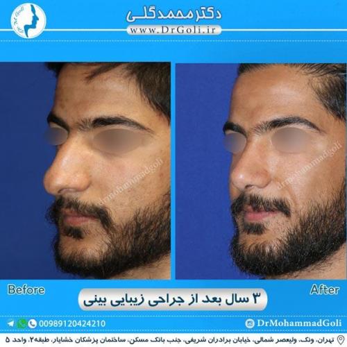 جراحی زیبایی بینی 188