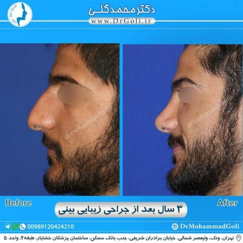 جراحی زیبایی بینی 190