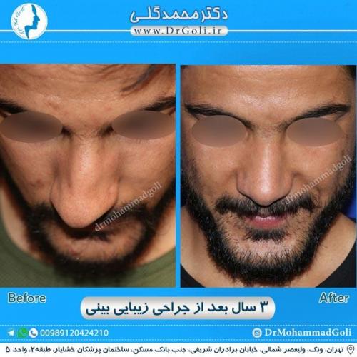 جراحی زیبایی بینی 191
