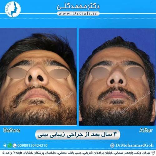 جراحی زیبایی بینی 192