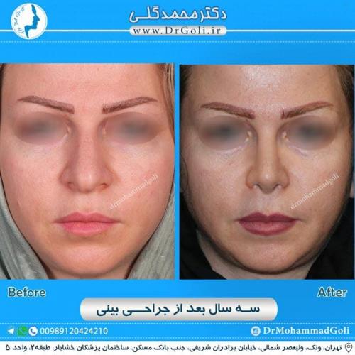 جراحی زیبایی بینی 193