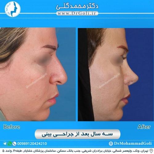 جراحی زیبایی بینی 194