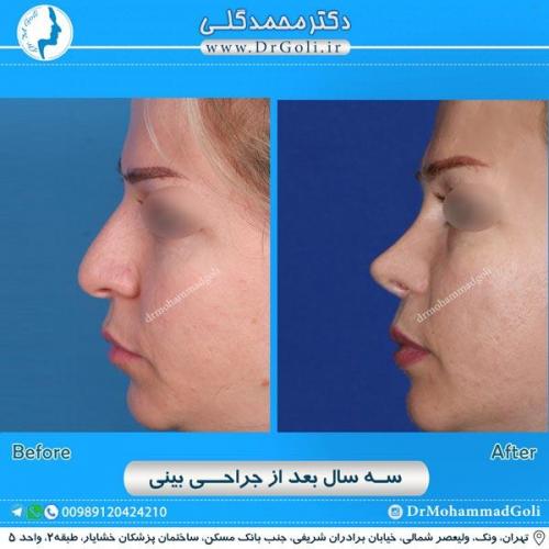 جراحی زیبایی بینی 195