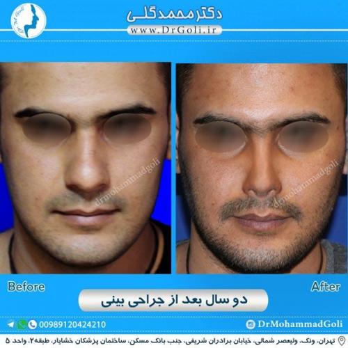 جراحی زیبایی بینی 196