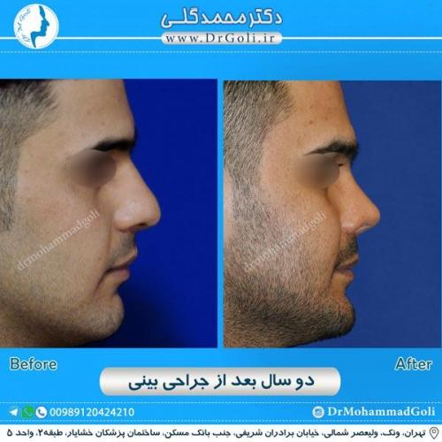 جراحی زیبایی بینی 197