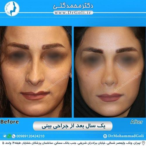 جراحی زیبایی بینی 203