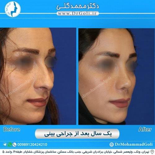 جراحی زیبایی بینی 204