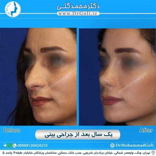 جراحی زیبایی بینی 205