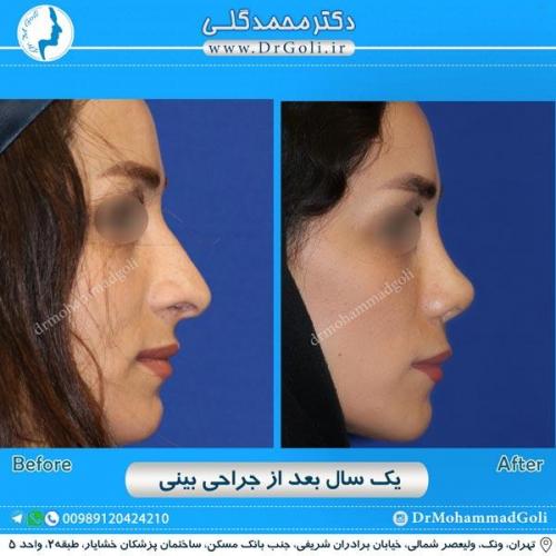 جراحی زیبایی بینی 206