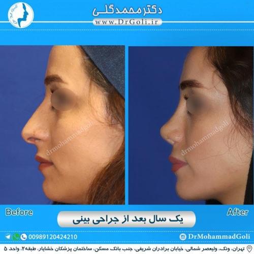 جراحی زیبایی بینی 207