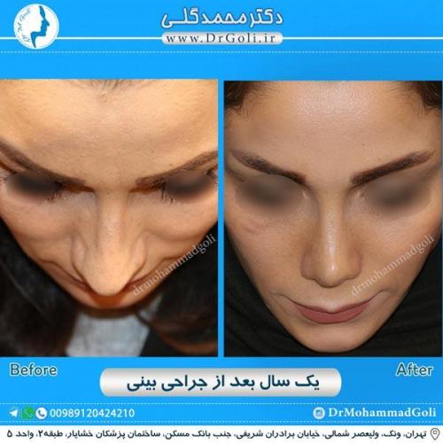 جراحی زیبایی بینی 208