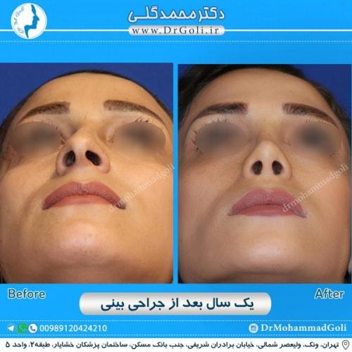 جراحی زیبایی بینی 209