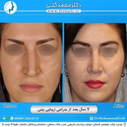 جراحی زیبایی بینی 210