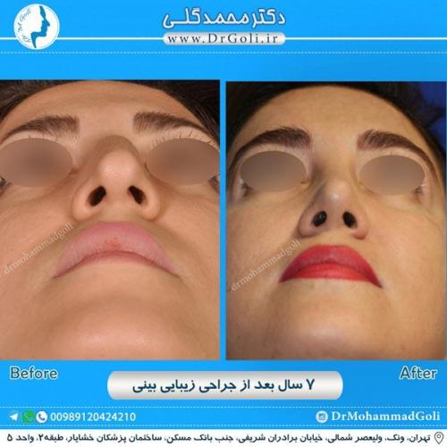 جراحی زیبایی بینی 211