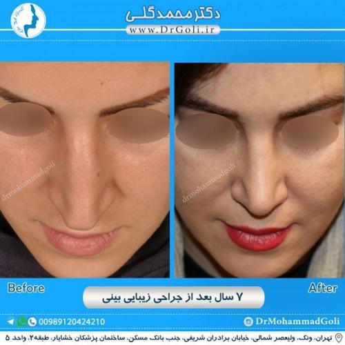 جراحی زیبایی بینی 212