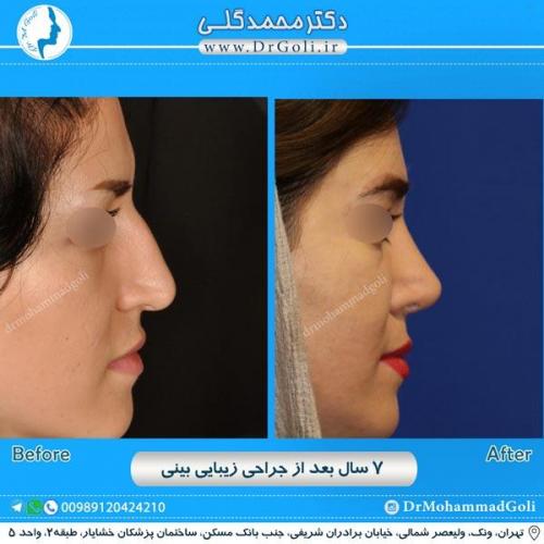 جراحی زیبایی بینی 213
