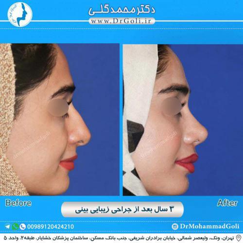 جراحی زیبایی بینی 219
