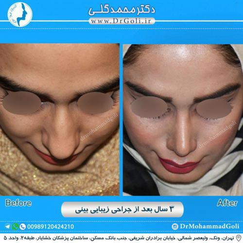 جراحی زیبایی بینی 221