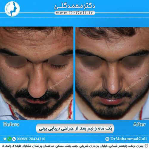 جراحی زیبایی بینی 240