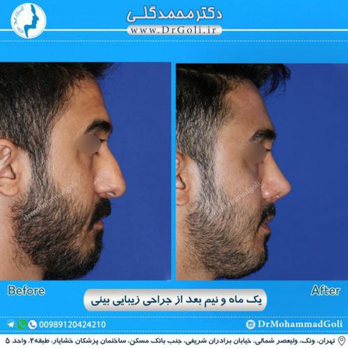 جراحی زیبایی بینی 241