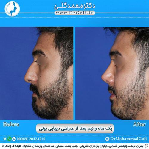 جراحی زیبایی بینی 242