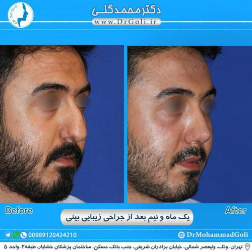 جراحی زیبایی بینی 243